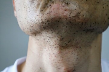 Naklejka premium レーザー脱毛直後の日本人男性の肌