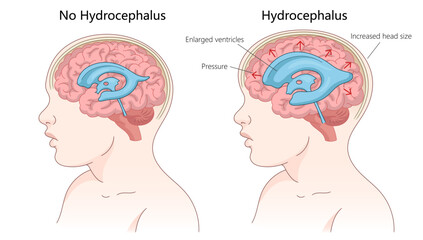 healthy brain versus a brain with hydrocephalus, enlarged ventricles, pressure, and increased head size diagram hand drawn schematic vector illustration. Medical science educational illustration