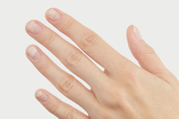 Fingernails with onycholysis after removing gel polish on grey background. Womans hand with damaged nails