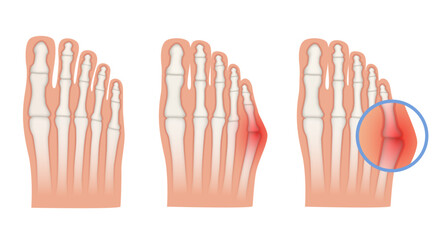 Obraz premium Taylor deformation. Valgus deformity of the little toe joint. Vector illustration.