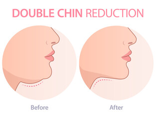 Vector illustration of a double. chin correction. Can be used for advertising purpose in cosmetology and aesthetic medicine. 