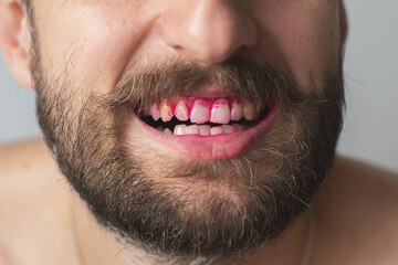 Obraz premium Close up of adult men s teeth with pink plaque indicator solution applied to teeth, concept of dental hygiene and health