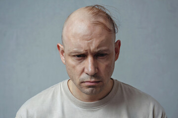 Sad bald man. The man's last hair is falling out.