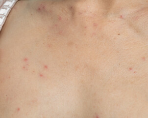 Woman with urticaria allergy itchy rash eczema itch neck from food,air poisoning,cosmetic,health,body vare disease lilness air,dissease medicine calamine lotion treatment,infection pain sick scratch.