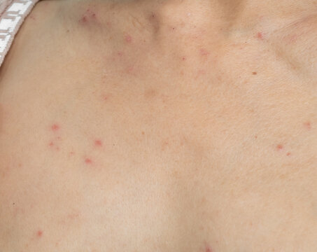 Woman with urticaria allergy itchy rash eczema itch neck from food,air poisoning,cosmetic,health,body vare disease lilness air,dissease medicine calamine lotion treatment,infection pain sick scratch.