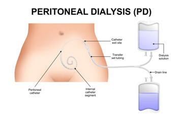 Peritoneal Dialysis (PD) illustration