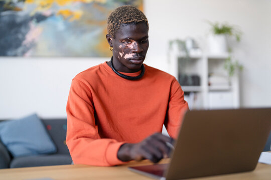 A young man with vitiligo dressed in an orange shirt types on a laptop while seated at a desk in a bright office with modern furniture and artwork, surrounded by a relaxed and professional atmosphere.