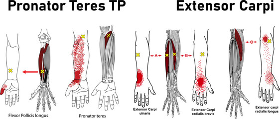 Myofascial Trigger Point, Pronator Teres TP, Extensor carpi