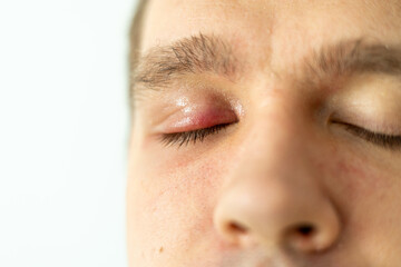 Selective focus on swollen and painful red upper eye lid with onset of stye infection due to...