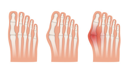 Obraz premium Hallux valgus. Valgus deformity of the big toe joint. Vector illustration.