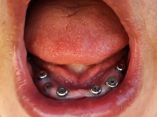 Dental implants, all in six, dental ceramic restoration, 19.