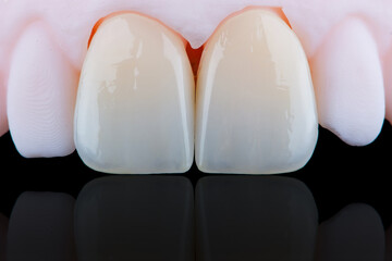 High-quality naturally dental single crowns made of zirconium for fixation to the frontal teeth of upper jaw. © gorynvd