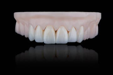 High-quality naturally dental single crowns made of zirconium for fixation to the frontal teeth of upper jaw.