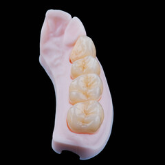High-quality naturally dental single crowns made of zirconium for fixation to the frontal teeth of upper jaw. © gorynvd