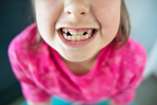 Young girl showing her missing baby teeth while smiling
