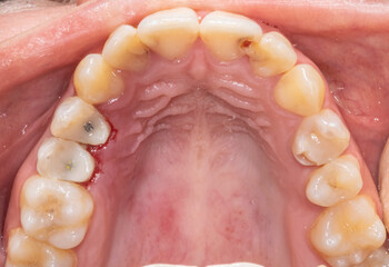 Occlusal view of a complete upper maxillary arch with restored teeth. Premolar crowns filled with resin composite and metallic post sealed on the root canal and dental caries on the incisors. © MSC