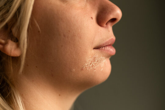 Facial skin peeling