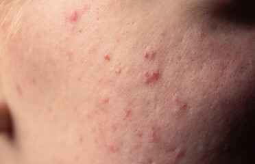 Dermatological acne. Skin texture background. Closeup acne pimple. Problem skincare. Pimples, acne,...