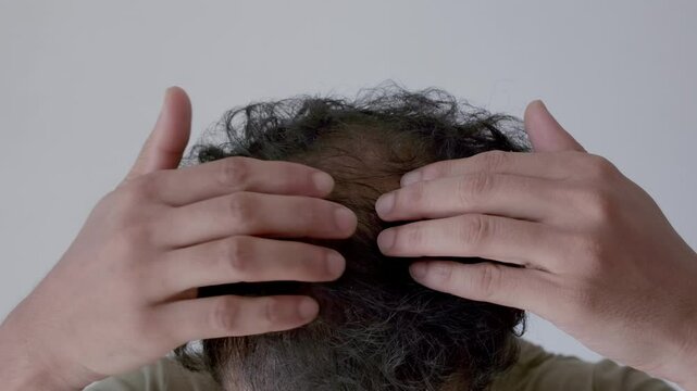 man suffering from androgenic alopecia showing his balding head in front of camera