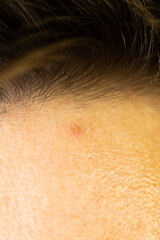 A pimple on a man's forehead. Acne on skin. Close up.