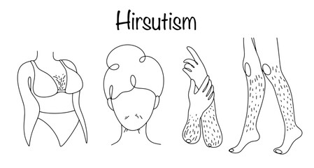 Hirsutism