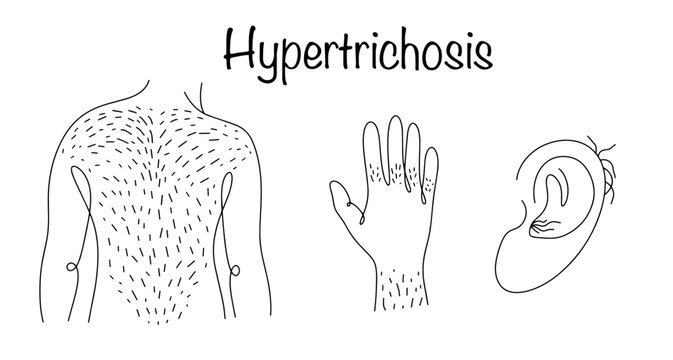 Hypertrichosis