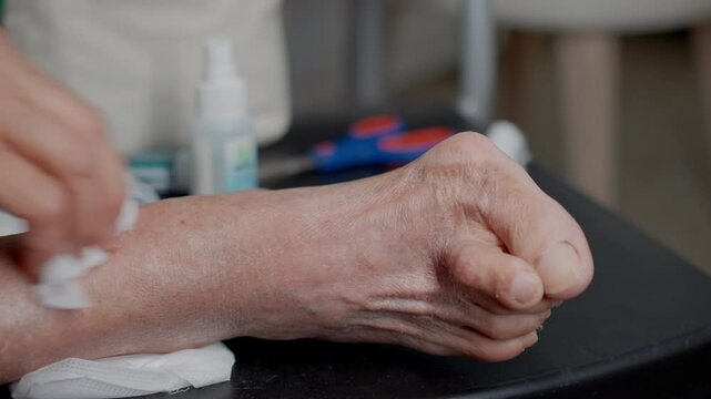Elderly woman foot with HALLUX VALGUS being cleaned with alcohol preparing for dressing while focusing on foot care and hygiene 