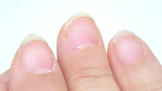 Compulsive nail and cuticle biting, Stress relief or self-harm, obsessive-compulsive disorder, mental health