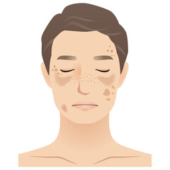 中年の男性　シミ　美容　老化