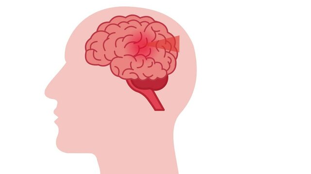brain atherosclerosis cerebral arteries stroke medical animation