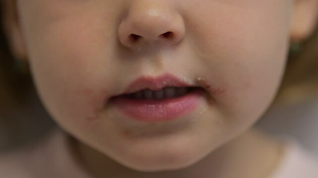 Child presenting symptoms of hand foot and mouth disease