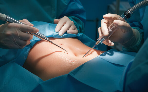 Surgeons performing laparoscopic minimally invasive surgery using instruments and camera