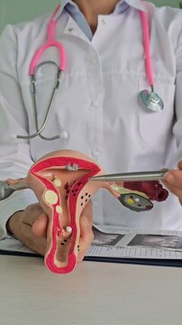 Doctor holding Uterus and Ovaries model. Ovarian and Cervical cancer, Cervix disorder vertical