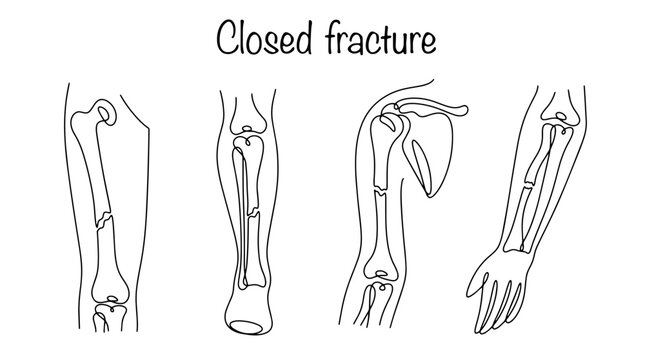 Closed fracture