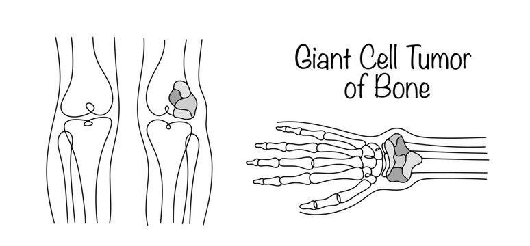 Giant Cell Tumor of Bone