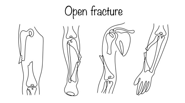 Open fracture