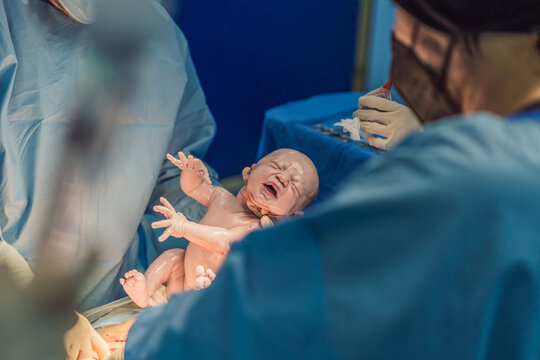 A baby is delivered during a caesarean section. The surgical procedure is conducted in a sterile operating room with a skilled medical team, ensuring the safety and health of both mother and baby