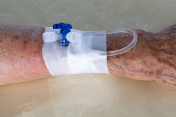 catéter venoso periférico en el antebrazo.
