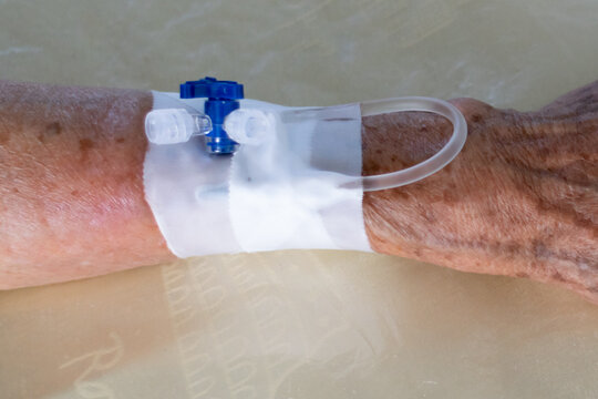 cat&eacute;ter venoso perif&eacute;rico en el antebrazo.
