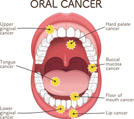 口腔がんの好発部位のイラスト　oral cancer illustration © 川本まる