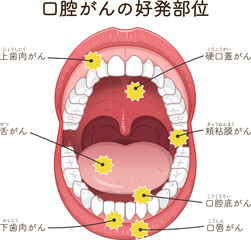 口腔がんの好発部位のイラスト　oral cancer illustration © 川本まる