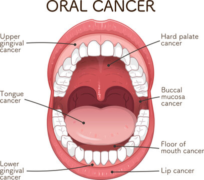 口腔がんの好発部位のイラスト　oral cancer illustration