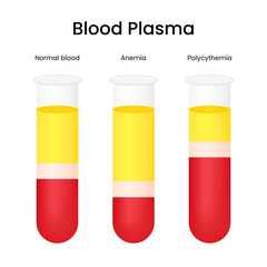 Blood Plasma of Normal Blood Anemia and Polycythemia