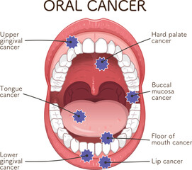 口腔がんの好発部位のイラスト　oral cancer illustration