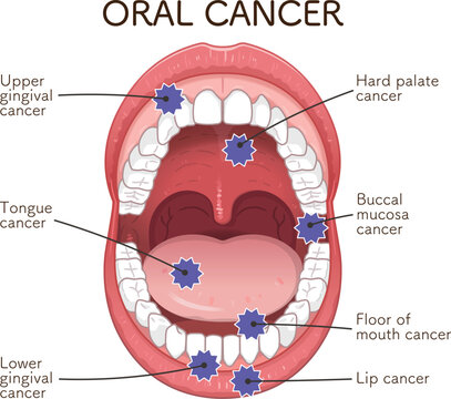 口腔がんの好発部位のイラスト　oral cancer illustration