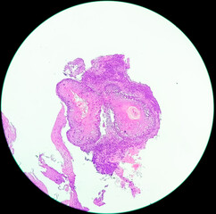 Esophageal squamous cell carcinoma G-2, light micrograph, photo under microscope