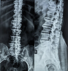 x ray of a spine shows Diffuse Idiopathic Skeletal Hyperostosis shortly DISH or Forestier Disease