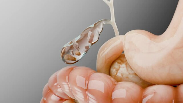 Gallstones in the gallbladderand bile duct, human silhouette and anatomy of surrounding organs, liver and gallbladder with stones, Realistic 3D Render	