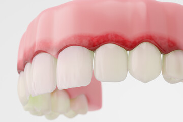 Fototapeta premium red, swollen gums with gingivitis disease white background. 3D rendering.