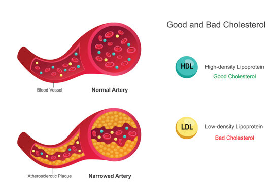 Good cholesterol (HDL) removes excess cholesterol from arteries, promoting heart health. Bad cholesterol (LDL) builds up in arteries, increasing heart disease risk.